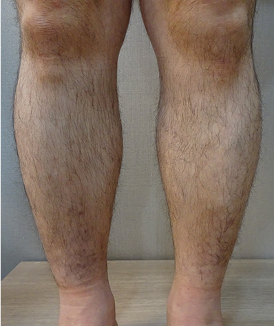 대복재정맥 역류 수술 후 개선된 표재성 혈전과 염증 모습