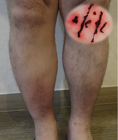 정맥 주행을 따라 통증과 염증성 부종이 발생한 치료 전 모습
