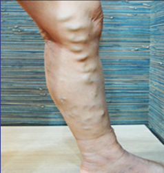 복합적인 하지정맥류 치료 전 돌출된 종아리 혈관 모습