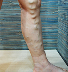 복합적인 하지정맥류 치료 전 종아리 측면 혈관 모습