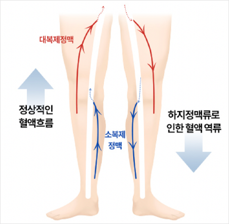 대복재정맥과 소복재정맥의 정상 혈액 흐름 및 하지정맥류 혈액 역류 비교