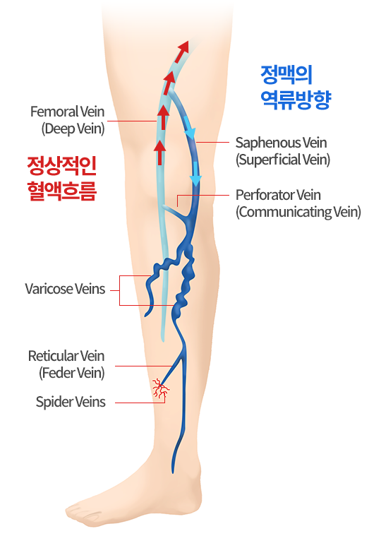 대퇴정맥과 표재정맥, 관통정맥 및 하지정맥류의 정상 혈액 흐름과 역류 방향