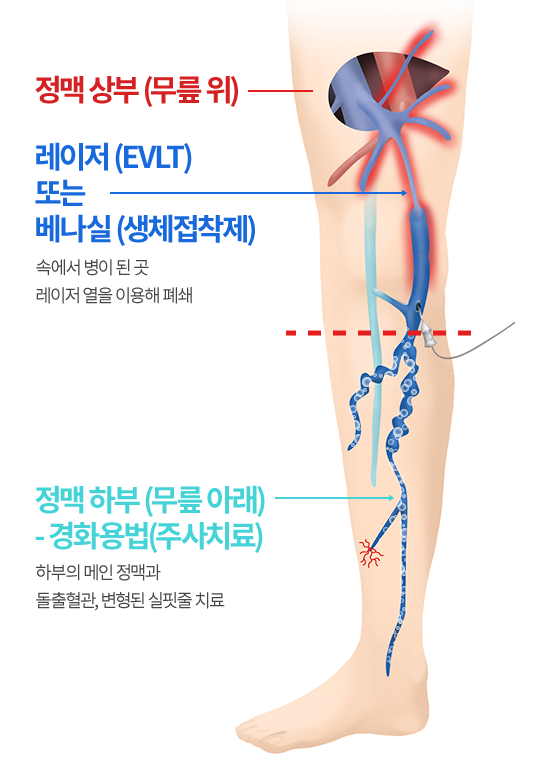 무릎 위 정맥은 레이저 또는 베나실로 폐쇄하고 무릎 아래 정맥은 경화요법으로 치료하는 과정