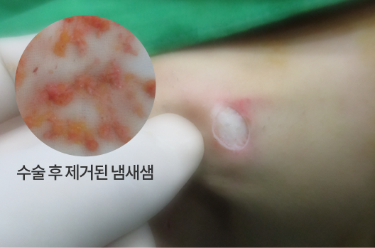 리포셋 재수술 후 한쪽 겨드랑이 모습