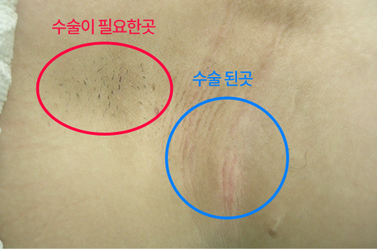 왼쪽 겨드랑이의 수술 필요 부위와 수술된 부위 비교