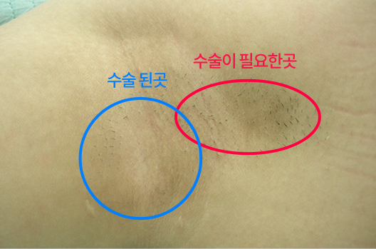 오른쪽 겨드랑이의 수술 필요 부위와 수술된 부위 비교