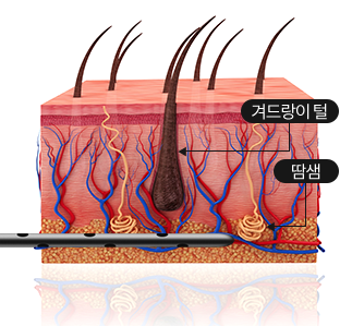 리포셋 캐뉼라를 이용해 겨드랑이 땀샘을 흡입하는 원리