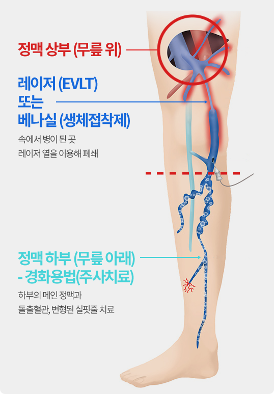 하지정맥류 비절개 하이브리드 치료 부위 안내