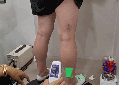다리의 정맥 위치를 아큐베인으로 확인하는 모습